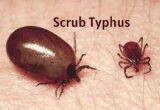 Scrub Typhus: